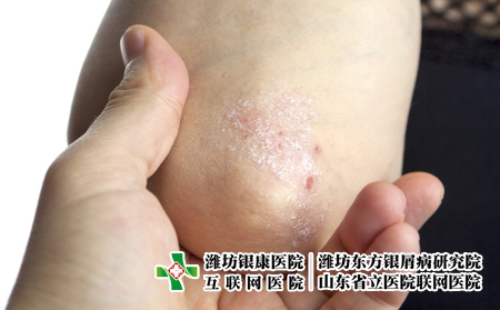 攝圖網_502556199_手肘上的絲蟲（企業商用）