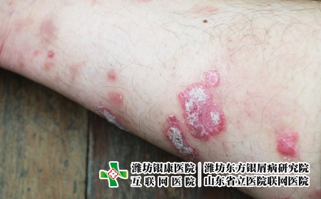 攝圖網_323551459_絲蟲病宏觀藥品疾病彎頭發癢病人醫療皮膚手臂皮炎（企業商用）