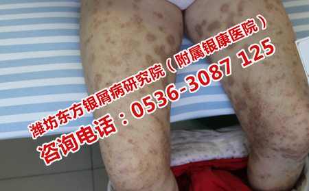 治療銀屑病的專科醫院