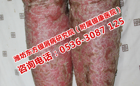 銀屑病的專業護理