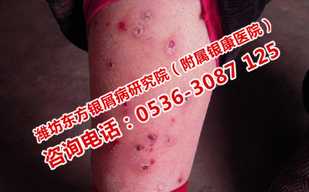哪家醫院治療牛皮癬理想