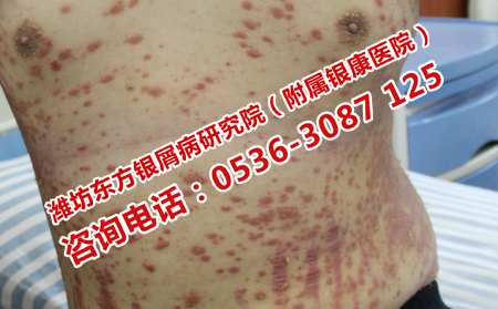 濰坊牛皮癬醫院回怎樣治療牛皮癬