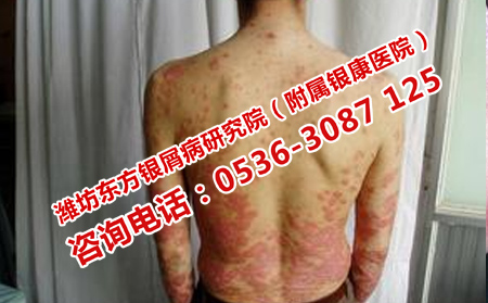 怎樣樹立心態(tài)治療銀屑病