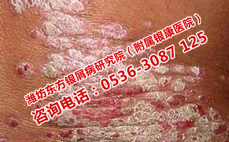 牛皮癬的預防方法有哪些
