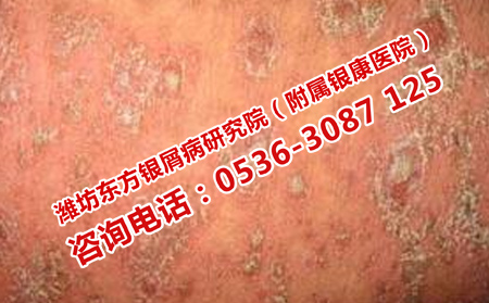 濰坊地區(qū)治療牛皮癬