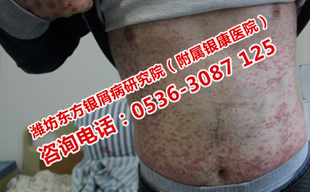 總是反復(fù)的牛皮癬治療