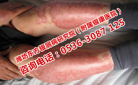 治療牛皮癬效果格外理想的醫(yī)院
