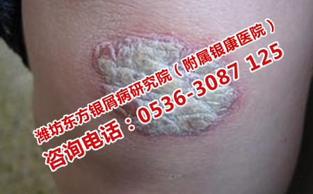 中醫治療牛皮癬的特點是什么