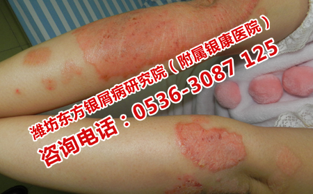 濰坊牛皮癬醫(yī)院用什么方法治療牛皮癬