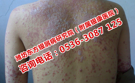 不斷加重的牛皮癬怎么治療