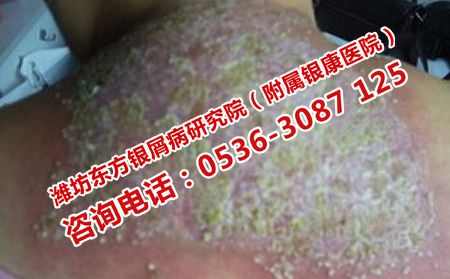 治療牛皮癬的重點