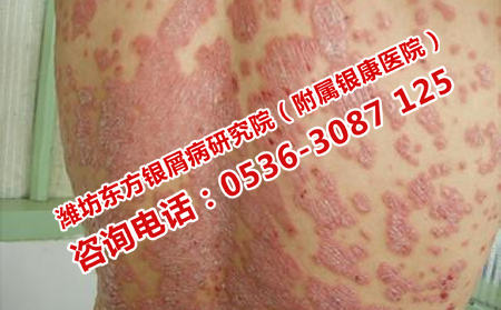哪些習慣對牛皮癬治療理想