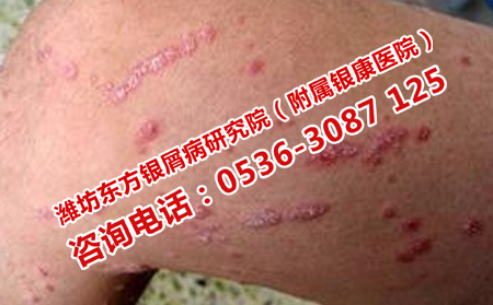 治療銀屑病治療效果理想的醫院