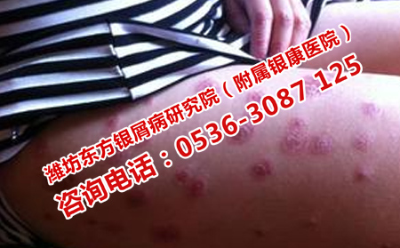 濰坊治牛皮癬的皮膚病醫院