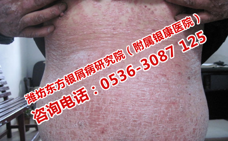 牛皮癬容易復(fù)發(fā)要怎樣護(hù)理