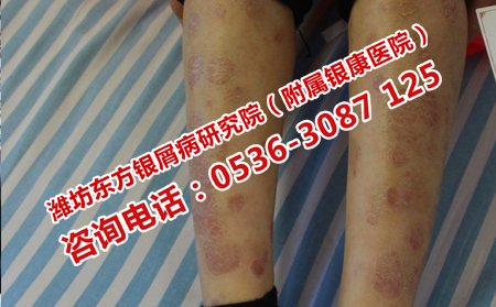 銀屑病恢復之后需要護理