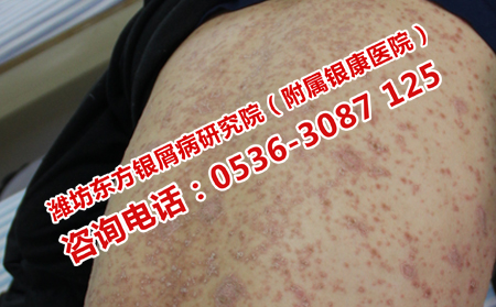 青州專門治銀屑病醫(yī)院