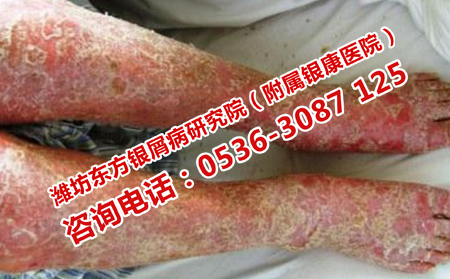壽光理想的男性銀屑病醫院