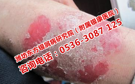 濰坊牛皮癬醫院是如何治牛皮癬的