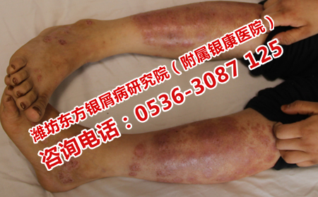 導致銀屑病復發的因素