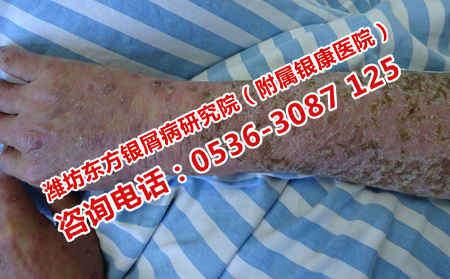 有效護理銀屑病的方法
