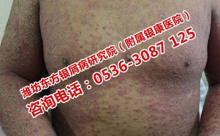中醫治療銀屑病的醫院