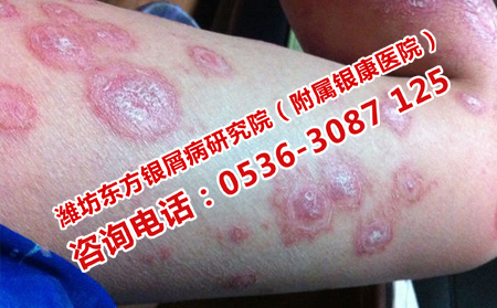 濰城區看銀屑病