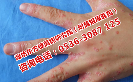 反復(fù)發(fā)作的銀屑病去哪里治
