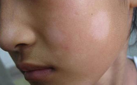 預(yù)防白癜風(fēng),預(yù)防白癜風(fēng)方法