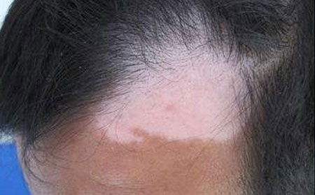 治療白癜風(fēng),藥物治療白癜風(fēng),濰坊治療白癜風(fēng)醫(yī)院