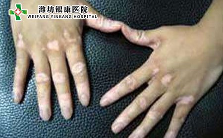 白癜風(fēng)傳染嗎,白癜風(fēng)會(huì)不會(huì)傳染