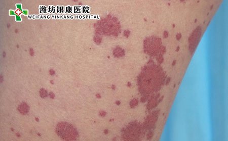 什么是過敏性紫癜癥狀有哪些?嚴(yán)重嗎?